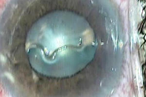 Kinh hãi, giun dài 14mm “bơi lội”, làm tổ trong mắt người phụ nữ