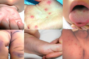 Hơn 65.000 trường hợp bị tay chân miệng