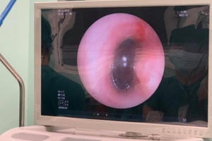 Suýt mất mạng vì hóc hạt sapôchê