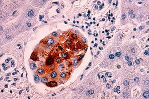 Phương pháp mới phát hiện ung thư trong 10 phút