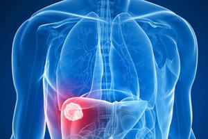 Sự nguy hiểm của ung thư gan thứ phát