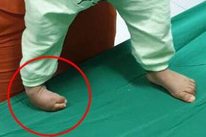 Bác sĩ "uốn" chân cong thành thẳng cho bé 16 tháng tuổi