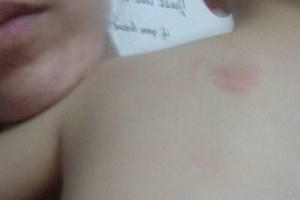 Bé trai 20 tháng tuổi ở Hà Nội bị cắn tím lưng khi trở về từ trường mầm non