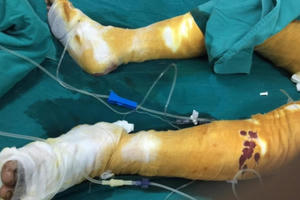 Đốt nhầm can xăng hai vợ chồng bị bỏng nặng