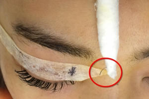 Nhấn mí chìm: Tưởng đẹp “hóa” tai họa