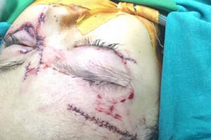 Bé gái 31 tháng tuổi thương tích nặng vì bị chó nhà tấn công