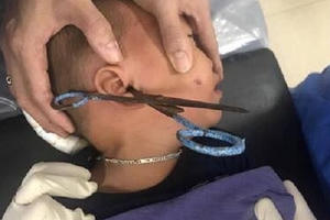 Mẹ bất cẩn, con 3 tuổi cầm kéo chơi bị đâm xuyên lỗ tai