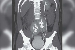 Phát hiện có tới 3… quả thận khi đi khám đau lưng