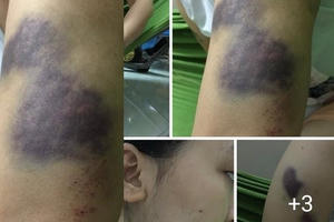 Bố đẻ nhẫn tâm hành hung con gái chấn động não