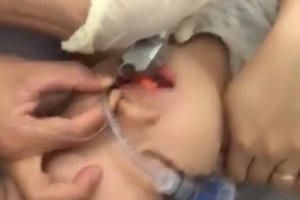 Cứu sống thần kỳ bé trai 2 tuổi ngưng tim, ngưng thở do hóc thạch rau câu