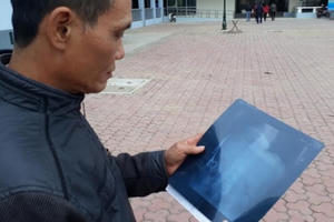 Vụ "quên kéo" trong bụng bệnh nhân 18 năm: Nếu ở thời điểm này thì rất nghiêm trọng