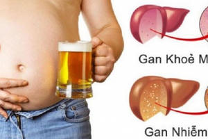 Hiểu nhầm tai hại khiến gan nhiễm mỡ Hiểu nhầm tai hại khiến gan nhiễm mỡ