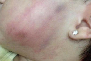 Hà Nội: Nghi án giáo viên mầm non tát bé gái 16 tháng tuổi bầm tím mặt