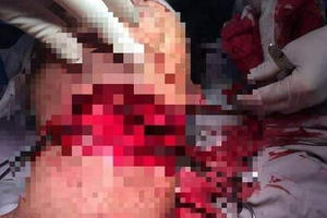 Lâm Đồng: Chồng dùng dao cắt cổ vợ rồi tự sát, cả 2 may mắn thoát chết