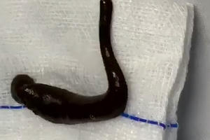 Đỉa trâu dài 15cm ngoe nguẩy trong khí quản người đàn ông