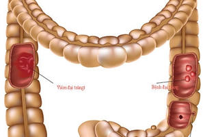 Bí kíp của người Nhật đẩy lùi viêm đại tràng đơn giản mà hiệu quả