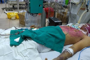 Tự mua thuốc chữa thủy đậu, nam thanh niên 28 tuổi bị suy đa tạng khó qua khỏi Tự mua thuốc chữa thủy đậu, nam thanh niên 28 tuổi bị suy đa tạng khó qua khỏi