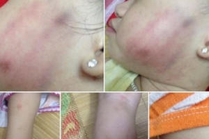 Nghi án bé 16 tháng tuổi bị cô giáo đánh bầm tím: Đây không phải lần đầu!