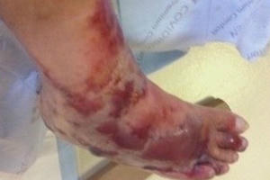 Người đàn ông bị vi khuẩn ăn thịt người “tấn công”