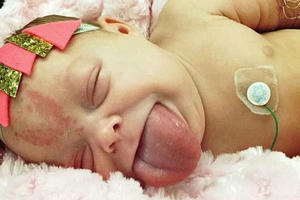 Trả lại nụ cười cho bé gái có lưỡi khổng lồ