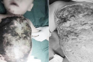 Xót xa, bé 13 tháng tuổi hoại tử, nhiễm trùng nặng vì chữa bỏng theo cách của thầy lang