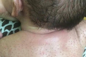 Chữa vặn mình cho trẻ bằng nước chanh và lòng trắng trứng: Cách làm phản khoa học