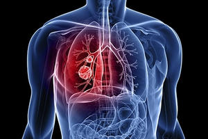 Những tác nhân gây ung thư phổi nguy hiểm hơn hút thuốc lá Những tác nhân gây ung thư phổi nguy hiểm hơn hút thuốc lá