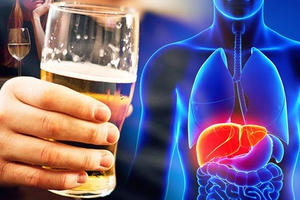 Ung thư gan, cái kết đau đớn của những "sâu rượu"