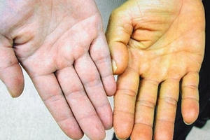 Dấu hiệu mắc ung thư gan bạn cần chú ý