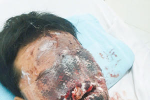 Bé trai 13 tuổi nguy cơ mất thị lực vì pháo nổ mua trên mạng Bé trai 13 tuổi nguy cơ mất thị lực vì pháo nổ mua trên mạng