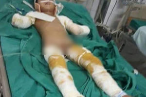 Xót xa, bé trai 12 tuổi bị điện phóng phải tháo bỏ 2 tay