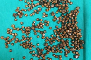 Hoảng hồn bác sĩ lôi ra 400 viên sỏi trong túi mật bệnh nhân