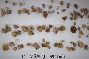 Hơn 90 viên sỏi “xếp hàng” trong cơ thể nam bệnh nhân