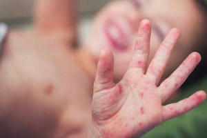 Một bệnh nhi tử vong do bệnh tay chân miệng