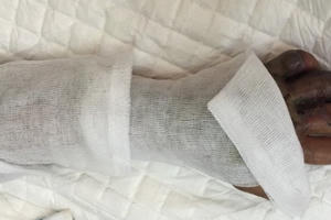 Sự thật về hạt đậu hút được mọi chất độc do côn trùng cắn