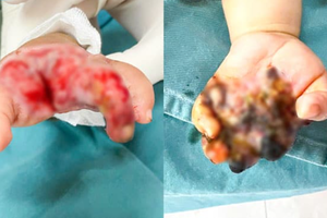 Bé 8 tháng tuổi bị hoại tử bàn tay do tai nạn máy tuốt lúa