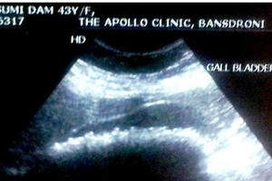 Bác sĩ sợ hãi loại bỏ 360 viên sỏi trong cơ thể cô gái sau 1 giờ phẫu thuật