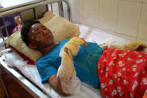 Lào Cai: Nổ khí gas, 10 người đang ăn cơm bị bỏng nặng