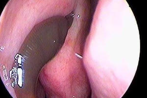 Clip - Rợn người cảnh quá trình gắp con đỉa dài 5 cm đang hút máu trong mũi nữ bệnh nhân