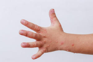 Bộ Y tế chỉ đạo khẩn tăng cường công tác phòng chống bệnh tay chân miệng