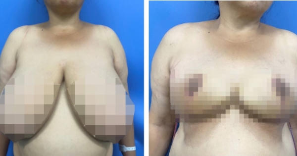 Bệnh viện Đại học Y Hà Nội phẫu thuật tái tạo vú phì đại khổng lồ hiếm gặp Bệnh viện Đại học Y Hà Nội phẫu thuật tái tạo vú phì đại khổng lồ hiếm gặp