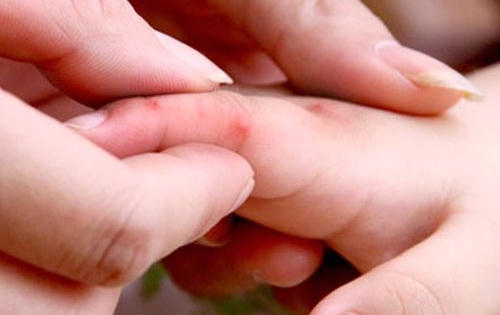 Quảng Ngãi: Bệnh tay chân miệng bùng phát mạnh