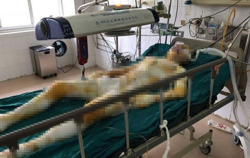 Thông tin mới nhất vụ nam thanh niên dùng xăng “thiêu” người tình ở Vĩnh Phúc: Gia cảnh khó khăn, thiếu nữ bị bỏng 92% Thông tin mới nhất vụ nam thanh niên dùng xăng “thiêu” người tình ở Vĩnh Phúc: Gia cảnh khó khăn, thiếu nữ bị bỏng 92%