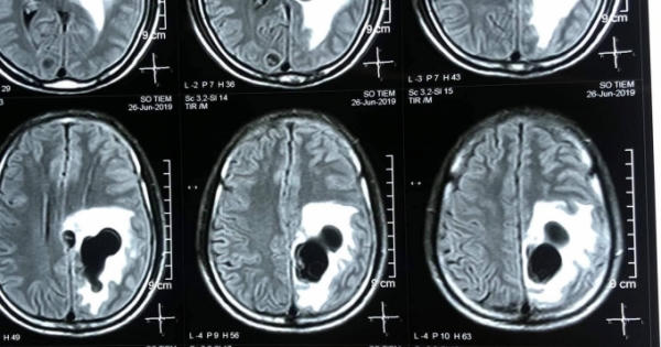 Chụp CT phát hiện 5 ổ sán làm tổ trong não nam bệnh nhân