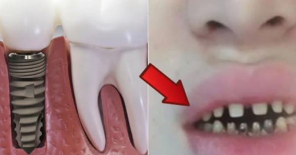 Nguy cơ tiềm ẩn đằng sau trào lưu răng sứ