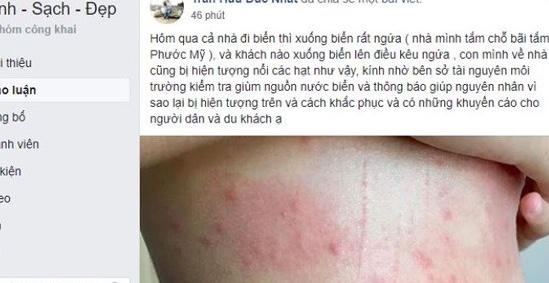 Tắm biển bị ngứa, nổi dị ứng tại Đà Nẵng: Có thể do sao biển và sứa