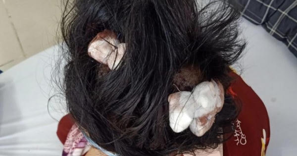Điều tra vụ việc bé gái 16 tuổi bị cha dượng đánh dập lá lách, gãy xương sườn