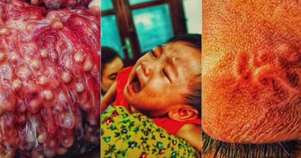 "Hé lộ" sự thật về căn bệnh ấu trùng sán bạn nên biết