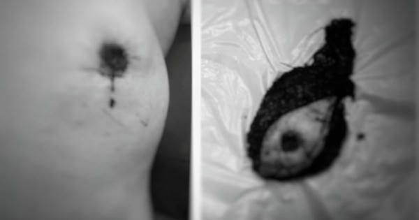 Mất núm vú vì chữa ung thư bằng thuốc Nam