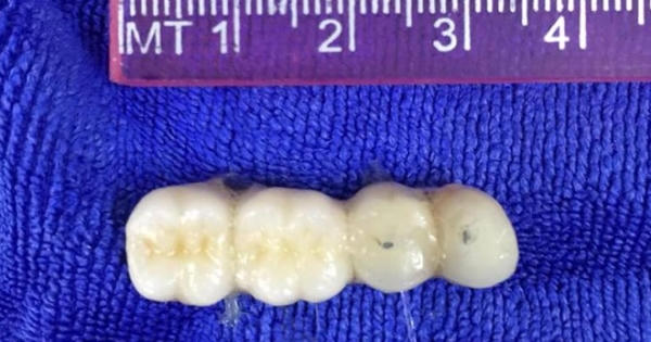 Suýt chết vì 4 chiếc răng giả rơi vào phế quản